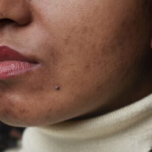 Close-up of a woman with acne, symbolizing the skin-healing and immune-boosting benefits of Howganics Zinc Shot