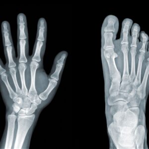 X-ray of hand and foot symbolizing bone health and strength from Howganics Vitamin D Injection